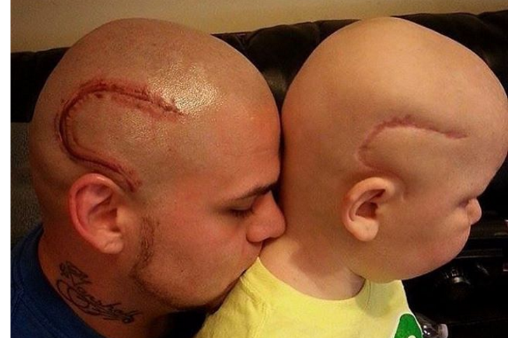 Si tatua la cicatrice del figlio operato al cervello